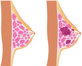 Breast cancer