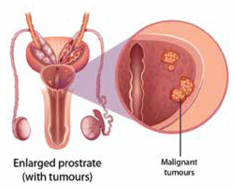 GU cancer