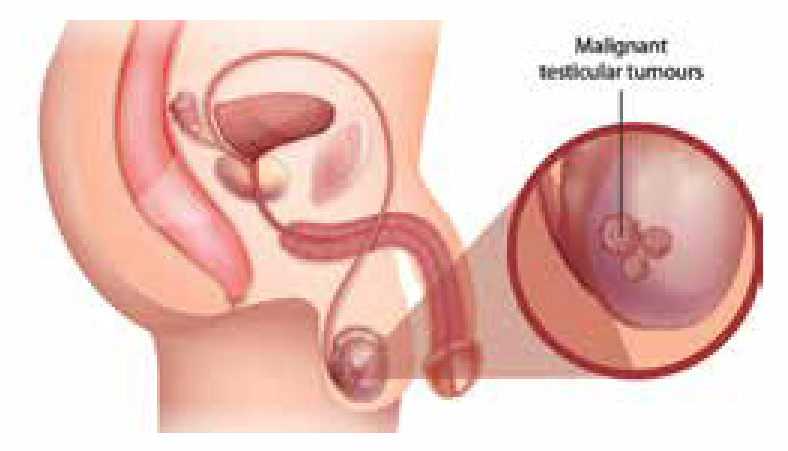 Of testicular cancer warning signs What are