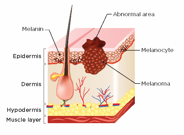 Skin cancer