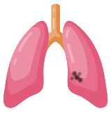 Lung cancer